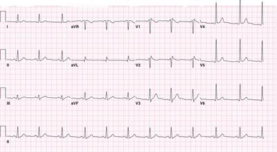 Unmasking of Brugada syndrome by <mark class="highlighted">lamotrigine</mark> in a patient with pre-existing epilepsy: A case report with review of the literature